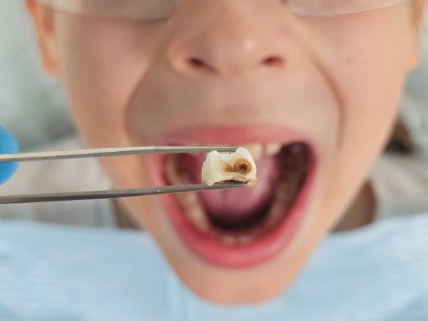 Best Emergency Treatment for Dental Infections or Abscesses in Ponchatou, LA