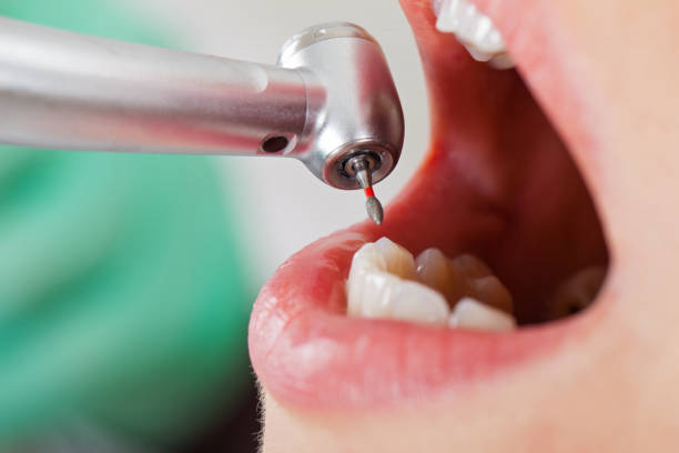 Best Cosmetic Emergency Dentistry in Ponchatou, LA